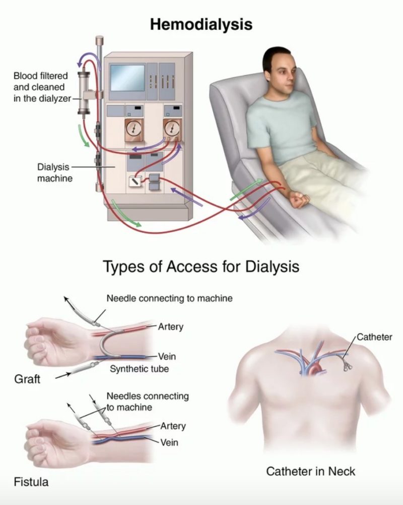 How dialysis works